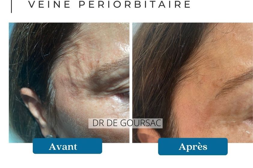 Traitement laser avant et après - 873839