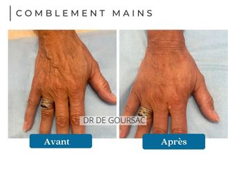 Traitement laser avant et après - 873861