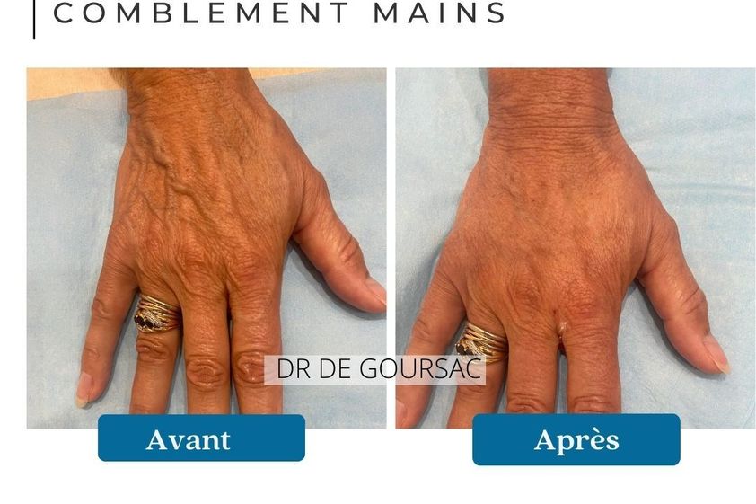 Traitement laser avant et après - 873861