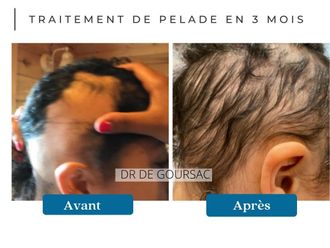 Traitement capillaire avant et après - 873862
