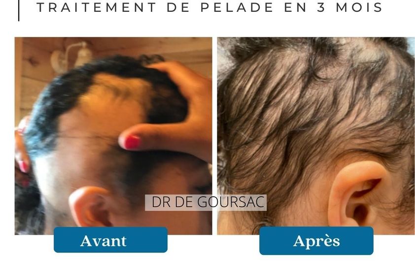 Traitement capillaire avant et après - 873862