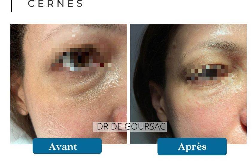 Cernes avant et après - 874195