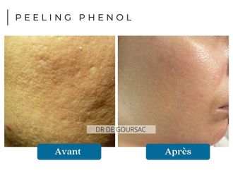 Peeling avant et après - 874199