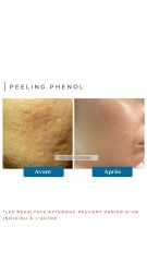 Peeling Phénol - Dr De Goursac