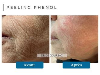 Peeling avant et après - 874200