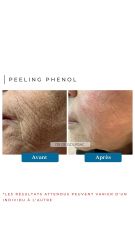 Peeling Phénol - Dr De Goursac