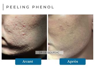 Peeling avant et après - 874530