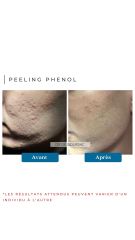 Peeling Phénol Dr de Goursac