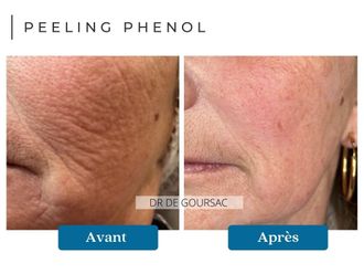 Peeling avant et après - 874531