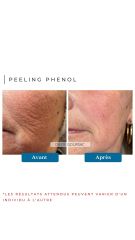 Peeling Phénol Dr de Goursac