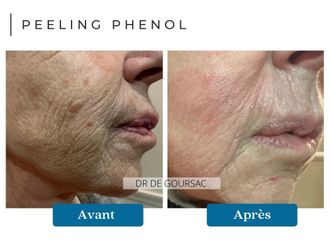 Peeling avant et après - 874532