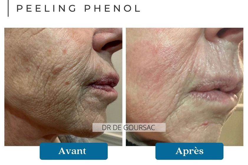 Peeling avant et après - 874532
