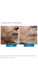 Peeling Phénol Dr de Goursac