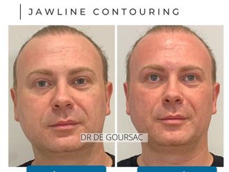 Lifting sans chirurgie avant et après - 874533