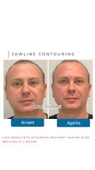 Jawline Contouring - Dr De Goursac