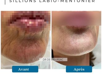 Acide Hyaluronique avant et après - 874534
