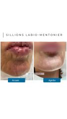 Sillions Labio-Mentonier Dr De Goursac