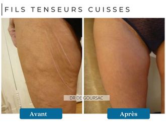 Fils tenseurs avant et après - 874536