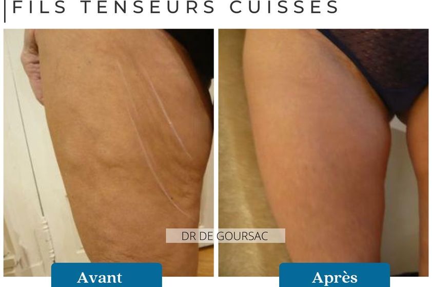 Fils tenseurs avant et après - 874536