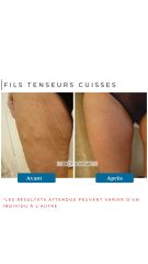 Fils Tenseurs Dr De Goursac