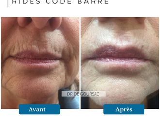 Acide Hyaluronique avant et après - 874537