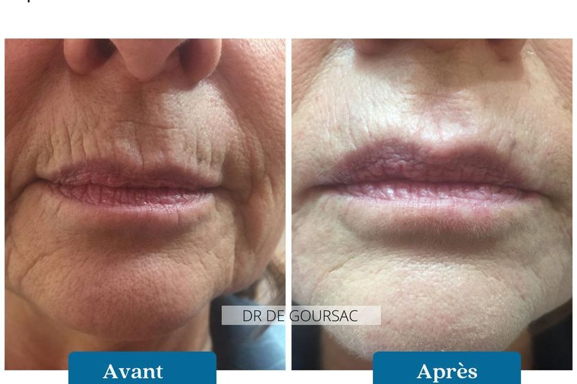 Acide Hyaluronique avant et après - 874537