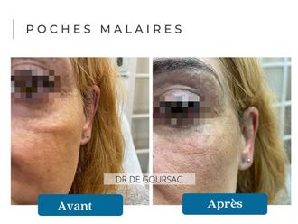 Radiofréquence avant et après - 874538