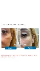 Poches Malaire - Dr De Goursac