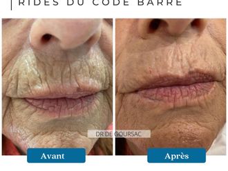 Acide Hyaluronique avant et après - 874539