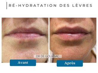 Acide Hyaluronique avant et après - 874659