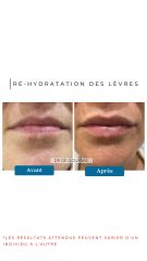 Ré-hydratation des lèvres