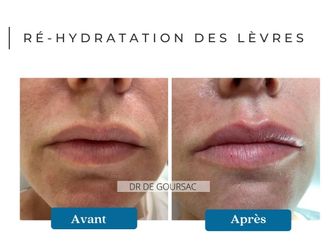Acide Hyaluronique avant et après - 874660