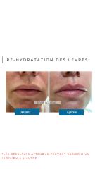 Ré-hydratation des lèvres