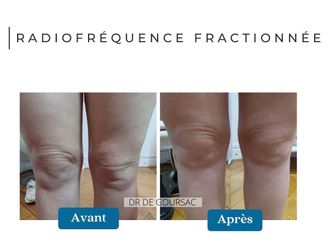 Radiofréquence avant et après - 874661