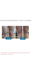 Radiofréquence fractionnée