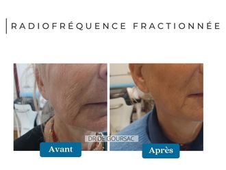 Radiofréquence avant et après - 874662