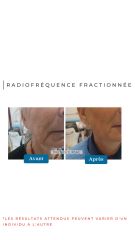 Radiofréquence Fractionnée