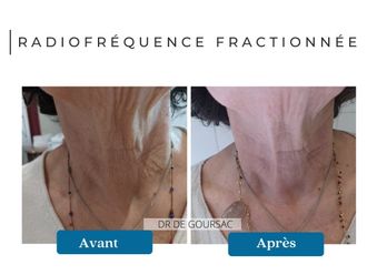 Radiofréquence avant et après - 874663