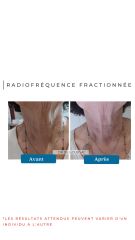 Radiofréquence fractionnée