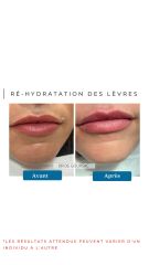 Ré-hydratation des lèvres