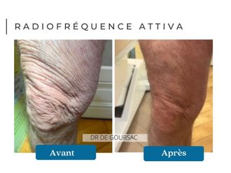 Radiofréquence avant et après - 874665