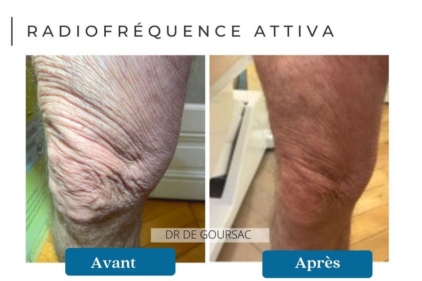 Radiofréquence avant et après - 874665