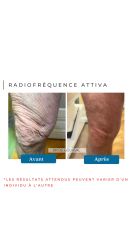 Radiofréquence Attiva