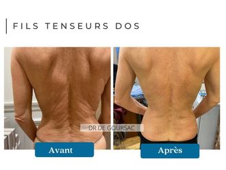Fils tenseurs avant et après - 875049