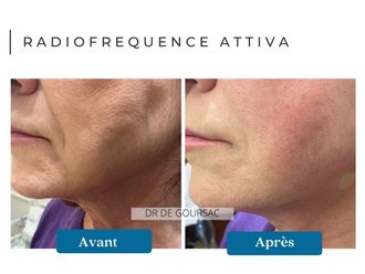 Radiofréquence avant et après - 875050