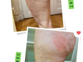 Radiofréquence avant et après - 875458
