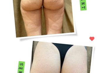 Traitement anti-cellulite avant et après - 875460