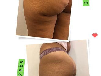 Traitement anti-cellulite avant et après - 875604