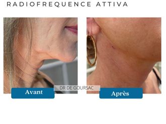 Radiofréquence avant et après - 876299