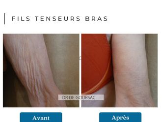 Fils tenseurs avant et après - 876300